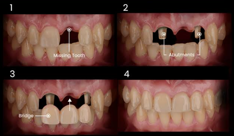 Dental Bridge: Types, Benefits, Procedure, Cost &amp; Aftercare